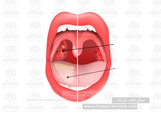 إلتهاب اللسان أسبابه وعلاجه في المنزل إلتهاب اللسان أسبابه وعلاجه في المنزل