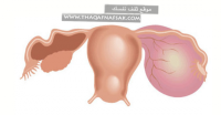 أعراض إنفجار أكياس المبيض و الأضرار الناتجة أعراض إنفجار أكياس المبيض و الأضرار الناتجة