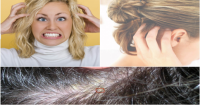 علاج الحكة في فروة الرأس بخلطات من الطب البديل علاج الحكة في فروة الرأس بخلطات من الطب البديل