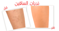 ندبات و بثور الساقين طرق علاجها طبيعيا بالصور