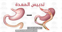 ماهي عملية تدبيس المعدة وأنواعها مضاعفتها وكل شئ عنها