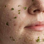 ماسك علاج حب الشباب للبشرة الجافة