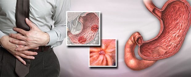أعراض قرحة المعدة التي لا يجب إغفالها وطرق علاجها أعراض قرحة المعدة التي لا يجب إغفالها وطرق علاجها