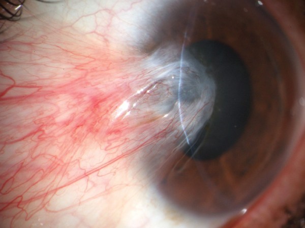 أحذر تأثير أشعة الشمس على العين