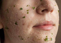 ماسك علاج حب الشباب للبشرة الجافة