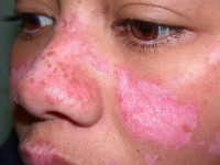 أسباب وأعراض مرض الذئبة وطرق علاجه والوقاية منه أسباب وأعراض مرض الذئبة وطرق علاجه والوقاية منه