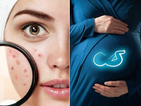 طرق آمنه لعلاج حبوب الشباب أثناء الحمل طرق آمنه لعلاج حبوب الشباب أثناء الحمل