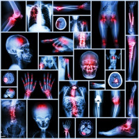 كيف تقلل حمض اليوريك في الدم للحماية من مرض النقرس و علاجه