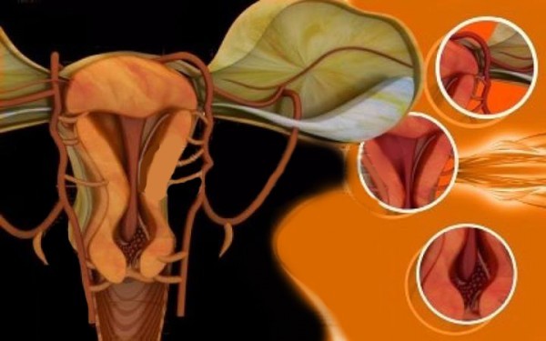 طريقة تنظيف الرحم بالاعشاب طريقة تنظيف الرحم بالاعشاب