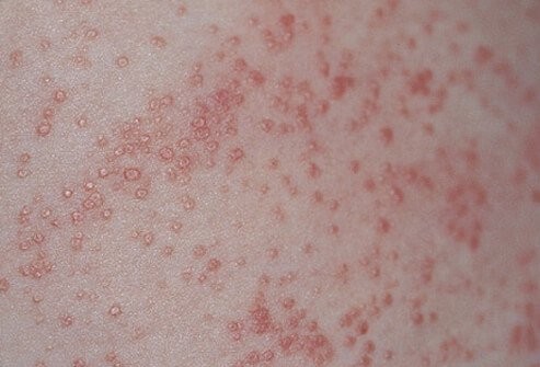 علاج الطفح الجلدي منزليا بـ ٥ طرق علاج الطفح الجلدي منزليا بـ ٥ طرق