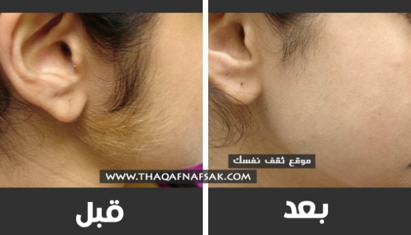 إزالة شعر الوجه بوصفات تجعله لا ينمو بارز وبكثره مرة أخرى إزالة شعر الوجه بوصفات تجعله لا ينمو بارز وبكثره مرة أخرى