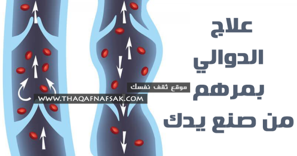 علاج الدوالي بمرهم الثوم و الليمون من صنع يدك علاج الدوالي بمرهم الثوم و الليمون من صنع يدك