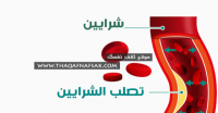 تصلب الشرايين الأعراض، الأسباب والعلاج بـ ٢١ طريقه طبيعيه تصلب الشرايين الأعراض، الأسباب والعلاج بـ ٢١ طريقه طبيعيه