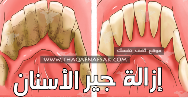 إزالة جير الأسنان ٢٤ طريقه نتائجها خلال ٣ أيام إزالة جير الأسنان ٢٤ طريقه نتائجها خلال ٣ أيام