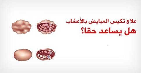 علاجات طبيعية لتكيس المبايض كيف تعالجي متلازمة تكيس المبايض بنفسك علاجات طبيعية لتكيس المبايض كيف تعالجي متلازمة تكيس المبايض بنفسك