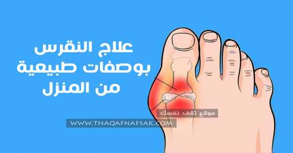 علاج النقرس بالطرق الطبيعية في المنزل
