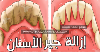 إزالة جير الأسنان ٢٤ طريقه نتائجها خلال ٣ أيام إزالة جير الأسنان ٢٤ طريقه نتائجها خلال ٣ أيام