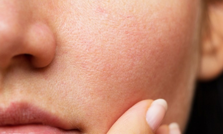 غلق مسام الوجه نهائياً غلق مسام الوجه نهائياً