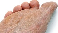 امراض القدم الجلدية امراض القدم الجلدية