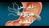 اعراض جرثومة المعدة بالتفصيل اعراض جرثومة المعدة بالتفصيل