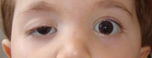 امراض العيون عند الاطفال بالصور المندب