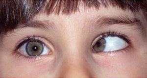 امراض العيون عند الاطفال بالصور المندب
