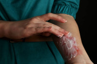 مراحل شفاء الحروق مراحل شفاء الحروق