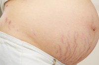 اثار الحمل اثار الحمل