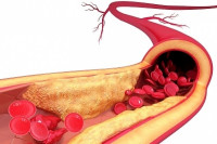 تصلب الشرايين تصلب الشرايين