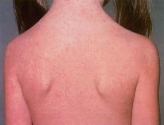 اعراض وعلاج الحصبة اعراض وعلاج الحصبة