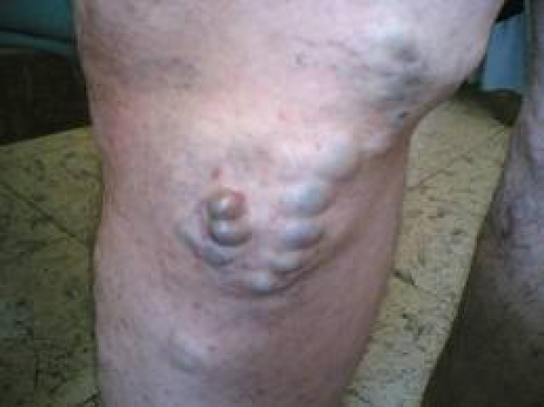 اسباب الدوالي وعلاجها