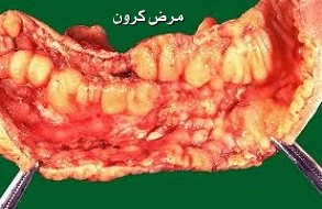 اعراض و علاج مرض كرون اعراض و علاج مرض كرون