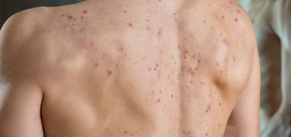 كيفية القضاء على حبوب وبثور الظهر كيفية القضاء على حبوب وبثور الظهر