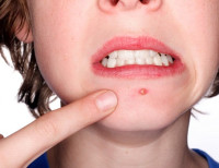 اسباب و علاج البثور وطريقة الوقاية منها