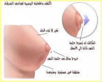 اسباب واعراض سرطان الثدي وعلاجه