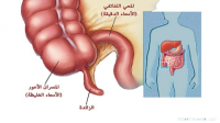 التهاب الزائدة الدودية التهاب الزائدة الدودية