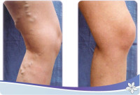 اسباب الدوالي وعلاجها اسباب الدوالي وعلاجها