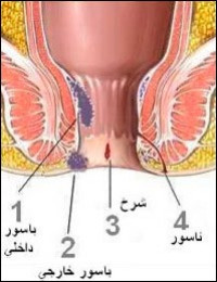 اعراض و اسباب وعلاج البواسير