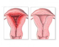 اسباب وعلاج حمى النفاس اسباب وعلاج حمى النفاس