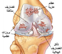 اعراض و علاج خشونة الركبة