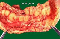 اعراض و علاج مرض كرون اعراض و علاج مرض كرون