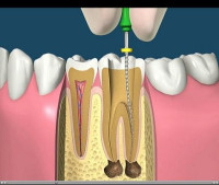 مخاطر حشوات الاسنان
