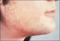 اسباب و علاج مرض الشعرانية