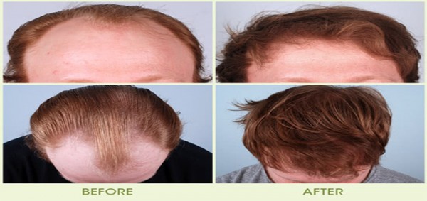 أحدث طرق زراعة الشعر بدون جراحة أحدث طرق زراعة الشعر بدون جراحة