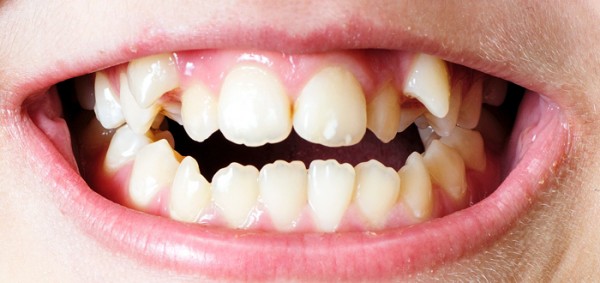 ظهور أسنان الطفل غير مرتبة .. ماذا افعل ؟