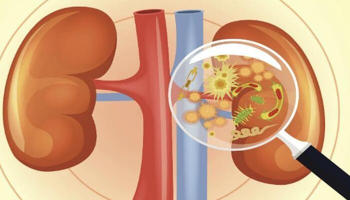 علامات الإصابة بعدوى في الكلى