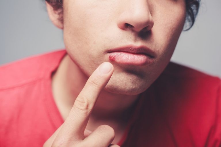 أفضل جل لعلاج قروح الفم أفضل جل لعلاج قروح الفم