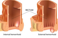 أخطر أنواع الناسور أخطر أنواع الناسور