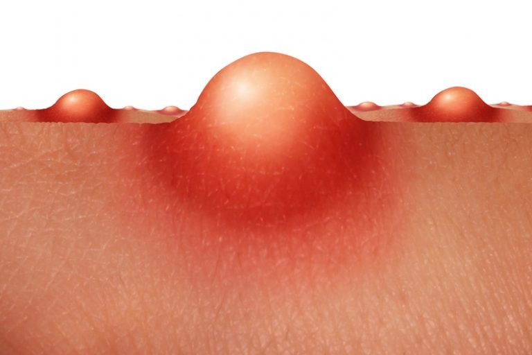 علاج الدمل في المؤخرة علاج الدمل في المؤخرة