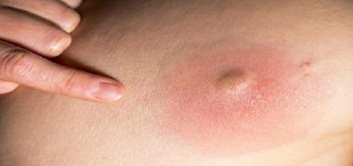 أسباب كثرة الخراج في الجسم